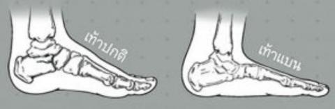 ภาวะเท้าแบน ส่งผลอย่างไรกับการดำเนินชีวิต