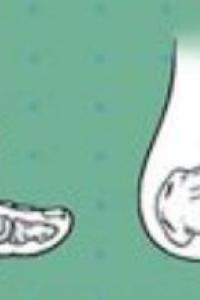 โรคเท้าแบนในเด็ก ภัยเงียบที่ผู้ปกครองต้องใส่ใจ